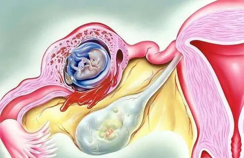 试管婴儿为什么要花那么多钱，试管婴儿胚胎移植后失眠了怎么办